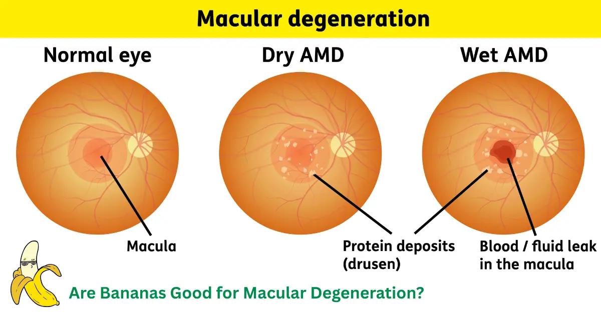 Are Bananas Good for Macular Degeneration? Eye Health Facts