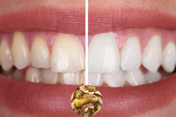 Do Banana Peels Whiten Teeth? Dentist-Backed Truth (2025)